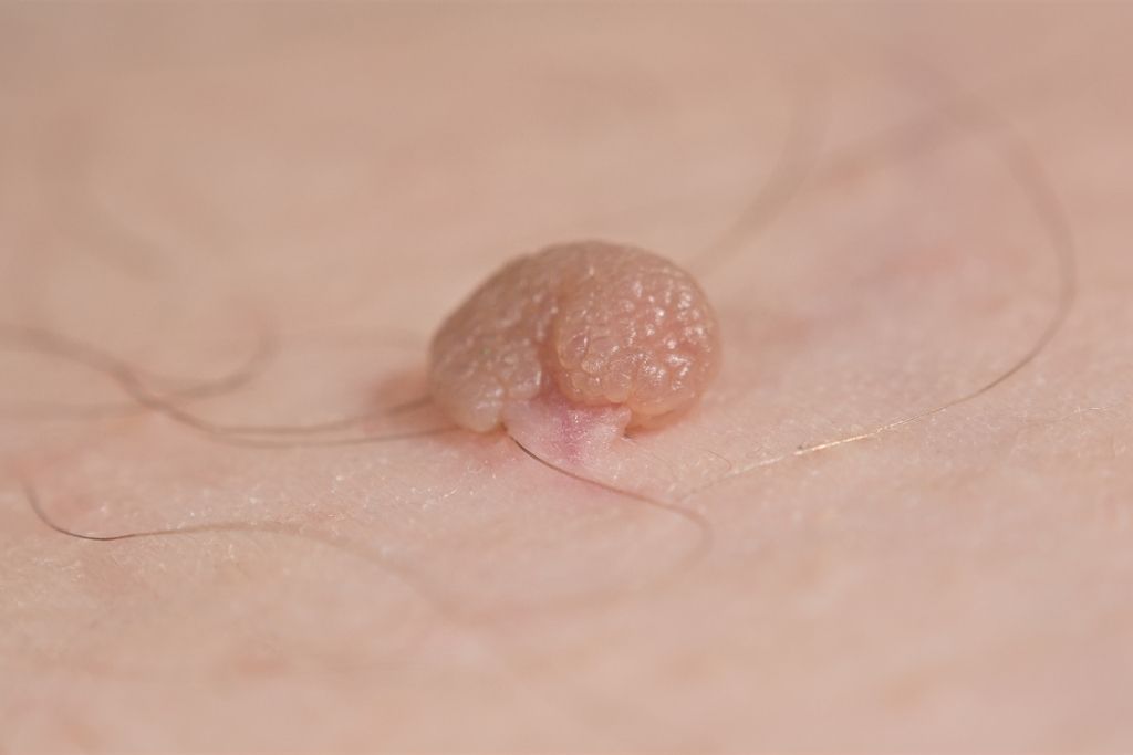 How To Remove Skin Tags At Home