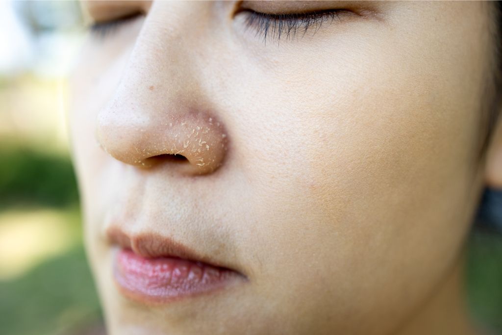 How To Get Rid Of Dry Flaky Skin Around Nose