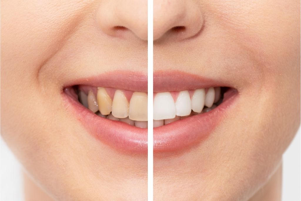 How To Whiten Yellow Teeth Safely For A Beautiful Smile
