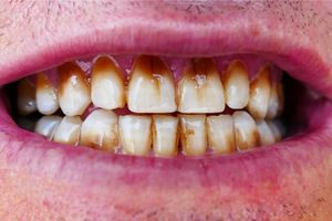 How To Get Rid Of Coffee Stains On Teeth