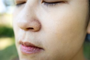 How To Get Rid Of Dry Flaky Skin Around Nose