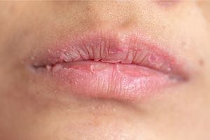 How To Get Rid Of Dry Skin On Lips