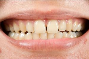 How To Get Rid Of Tea Stains On Teeth