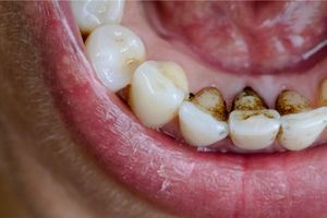 How To Get Rid Of Tobacco Stains On Teeth